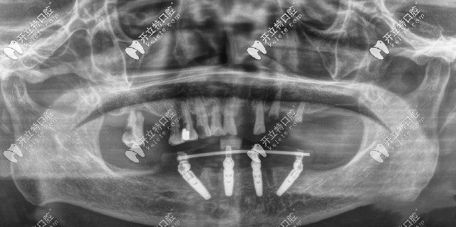 廣州廣大口腔ALLON4半口種植牙CT片