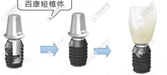 九龍這款植體一定程度上可避免植骨手術(shù)