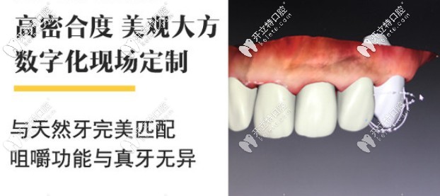 澤康、威蘭德、吉爾巴赫全瓷牙該選哪個牌子