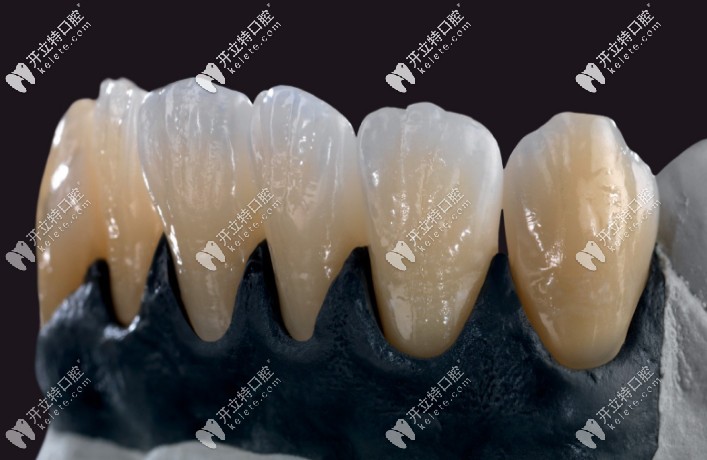 吉爾巴赫全瓷牙的優(yōu)點