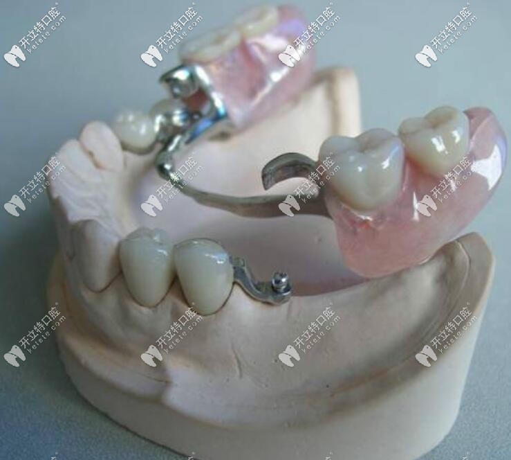 精密附著體義齒2萬有人說貴,原來正是這些缺點影響它的價格