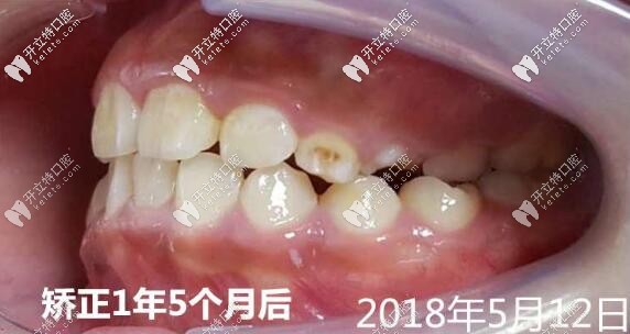孩子牙列畸形做矯正后的照片 孩子牙列畸形做矯正后的照片