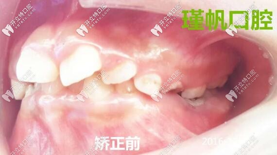牙齒畸形矯正前側(cè)面照片 牙齒畸形矯正前側(cè)面照片