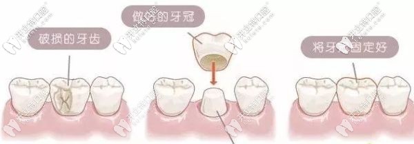 解答：門牙缺了一小塊是選牙齒貼面還是全瓷牙好呢？