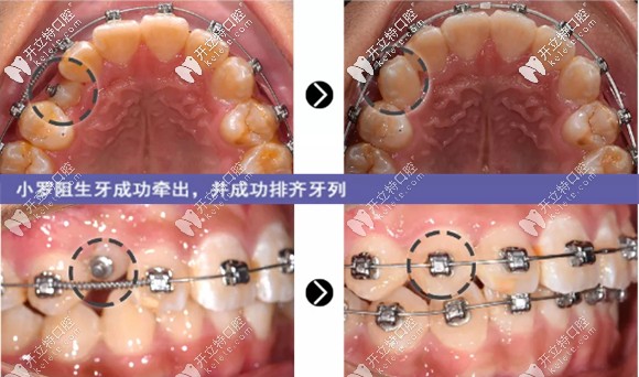 治療8個(gè)月，阻生牙成功牽出并成功排齊牙列