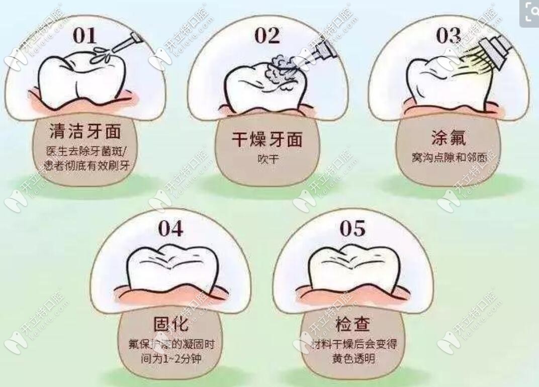 兒童口腔涂氟