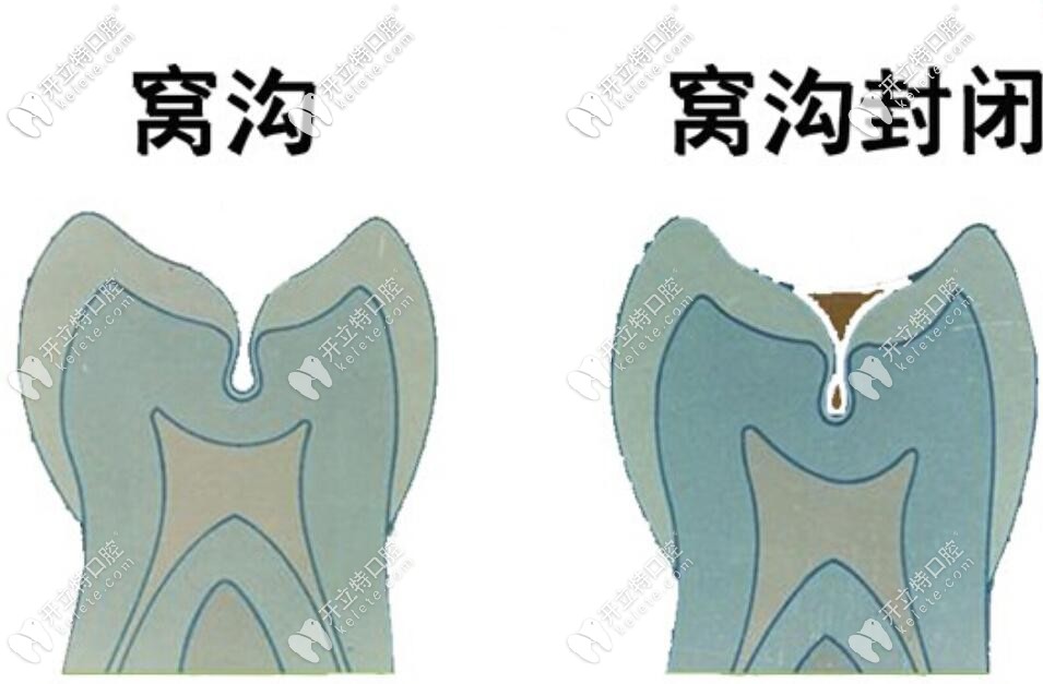 窩溝封閉