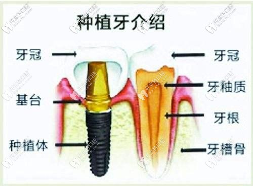 種植體和真牙的對(duì)比