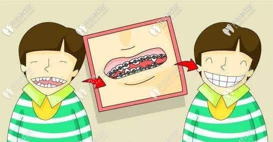 兒童矯正牙齒效果