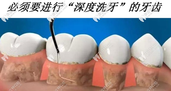 深度潔牙主要針對(duì)重度牙周病