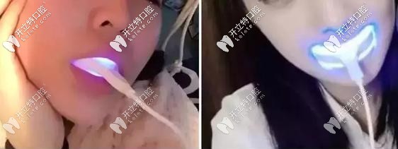 美牙儀會導致牙齦萎縮