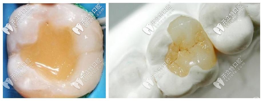 嵌體為什么老掉呢?假如牙嵌體掉了再粘回去要錢(qián)嗎？