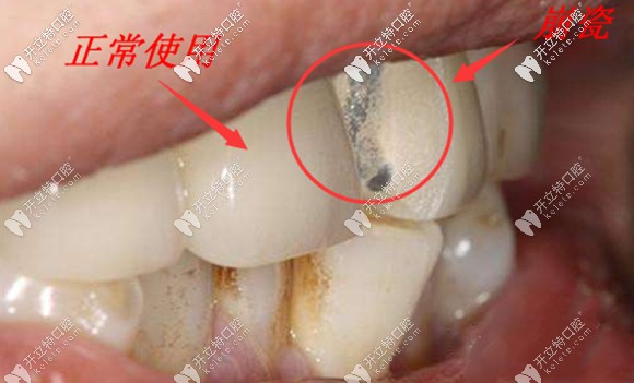 牙冠的合理設計也是影響使用壽命的重要因素