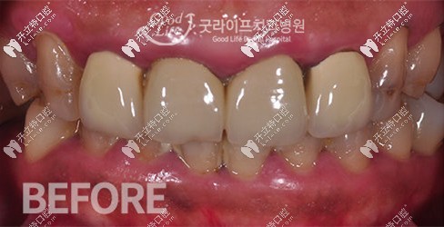 做牙齒貼面前牙齒狀態(tài) 做牙齒貼面前牙齒狀態(tài)