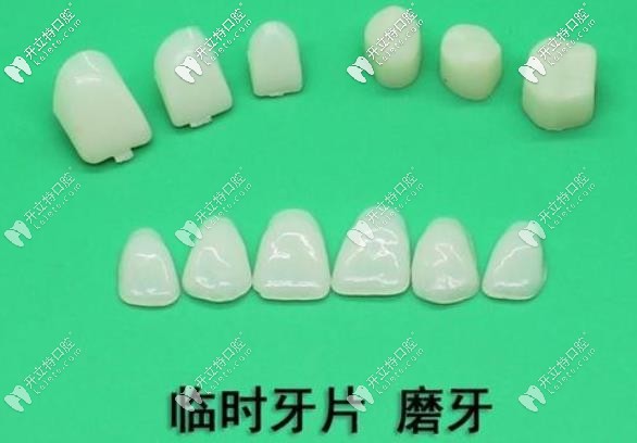 臨時牙貼面 臨時牙貼面