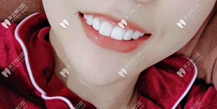 做完全瓷牙的效果圖