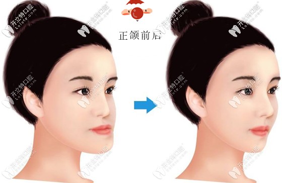  骨性地包天做完做正頜術(shù)后效果