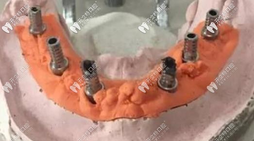 allon6種植牙示意圖