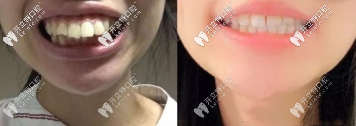 隱適美矯正齙牙前后對(duì)比照