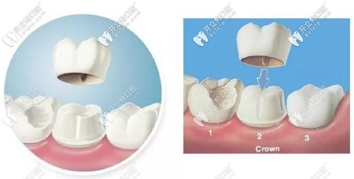 柏樂口腔鈷鉻牙冠