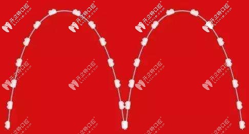 整牙時方弓絲和圓弓絲的區(qū)別