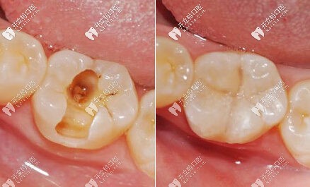 補(bǔ)牙的前后對(duì)比圖