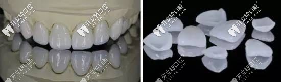 柏樂口腔全瓷牙齒貼面