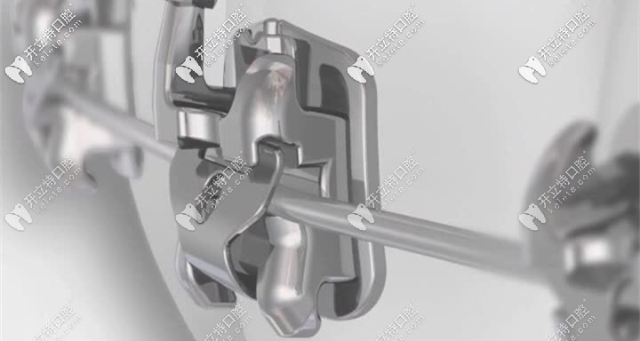 整牙時用到的自鎖托槽圓弓絲