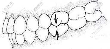 牙齒咬合關(guān)系不好