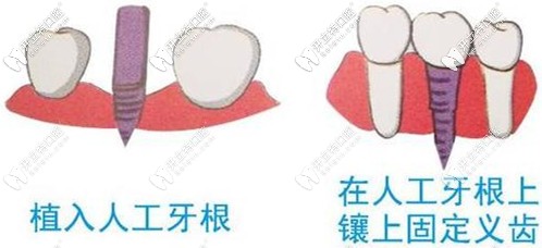 植入種植體后牙齒需要一定的時(shí)間愈合