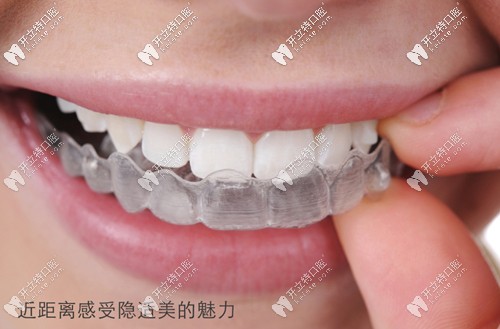董瑜醫(yī)生是隱適美和時代天使認證醫(yī)師