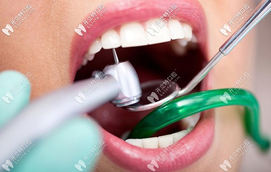 保護牙齒必須要做好口腔清潔衛(wèi)生，清除牙菌斑是關(guān)鍵