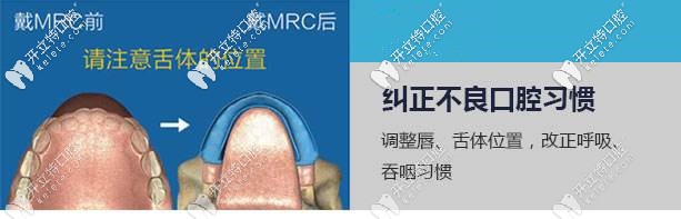 MRC矯正可以糾正不良口腔習慣