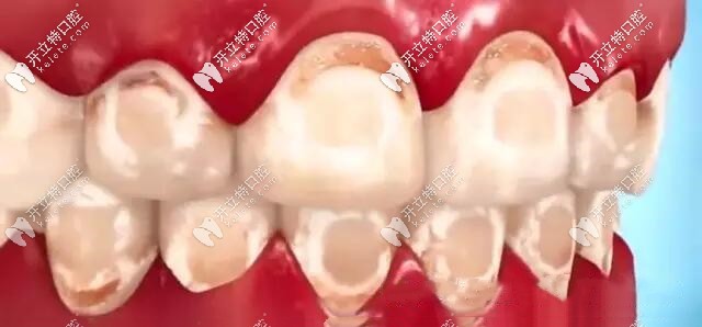 牙齒脫礦