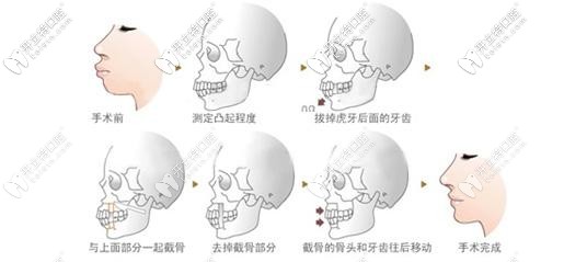 正畸和正頜手術(shù)聯(lián)合