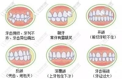 牙齒不齊的癥狀 牙齒不齊的癥狀