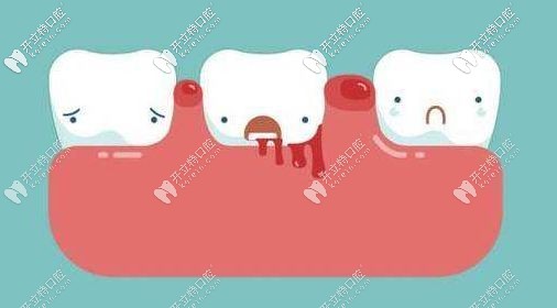 牙齦出血 牙齦出血