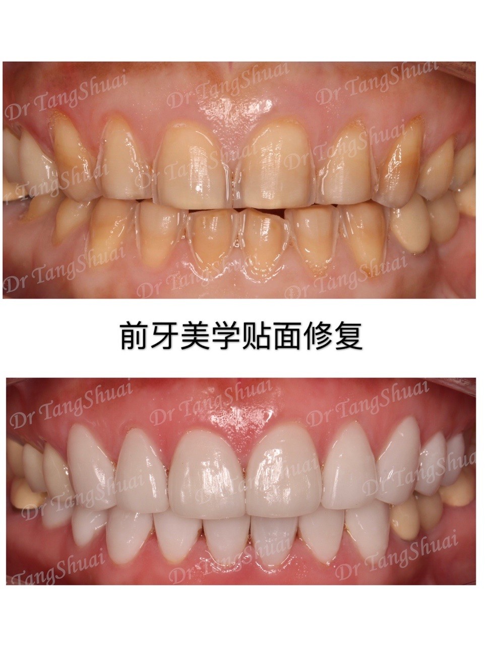 北京雅醫(yī)家口腔用我親身做貼面的感受給大家談?wù)勓例X貼面的優(yōu)缺點(diǎn)