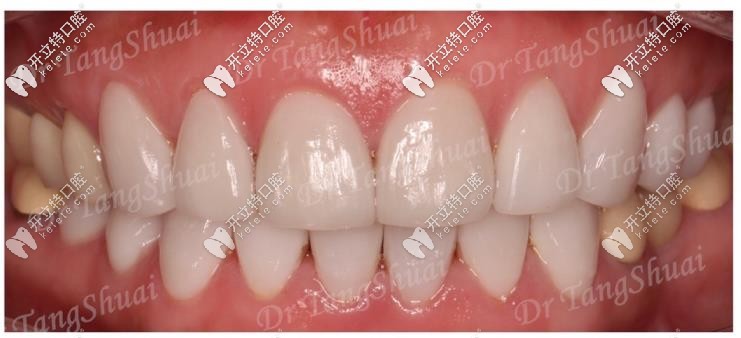 牙齒貼面后樣子