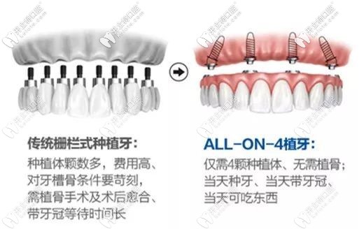 即拔即種半口種植牙