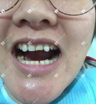 門牙磕斷了必須根管治療嗎?她還做了瓷貼面呢，超贊