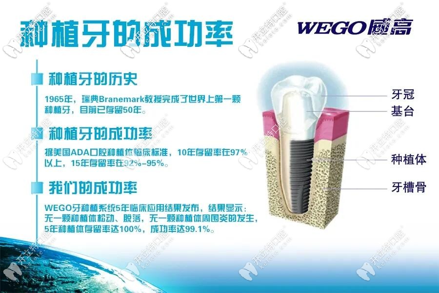 威高種植牙成功率說(shuō)明