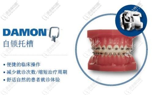 美國(guó)DamonQ金屬自鎖托槽