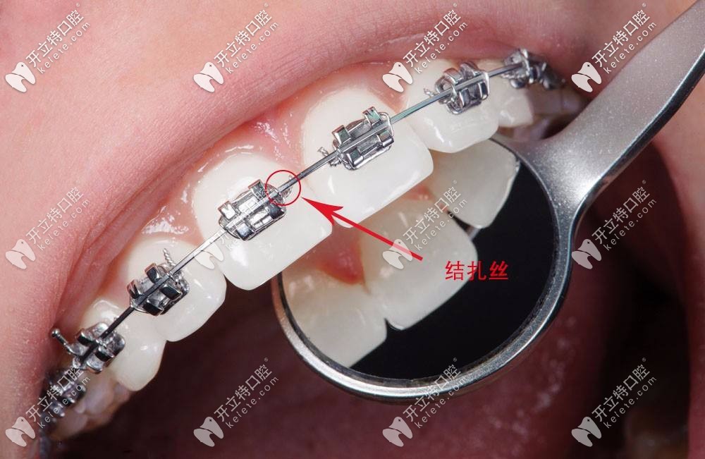 進(jìn)口自鎖金屬托槽