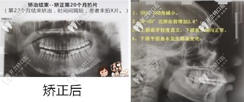 矯正結(jié)束后全景片和側(cè)位片