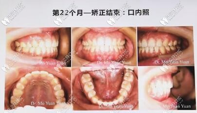 重慶維樂(lè)口腔金屬托槽矯正案例