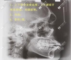 正畸側(cè)位片