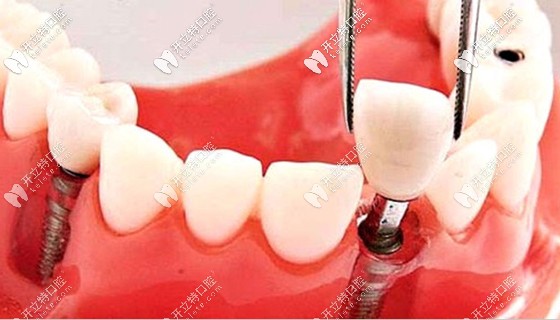 李紹軍醫(yī)師是瑞典N(xiāo)OBEL公司特聘種植醫(yī)師 李紹軍醫(yī)師是瑞典N(xiāo)OBEL公司特聘種植醫(yī)師