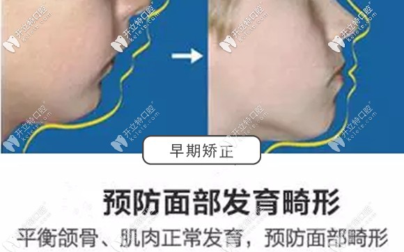 小孩子早期干預(yù)矯正的好處