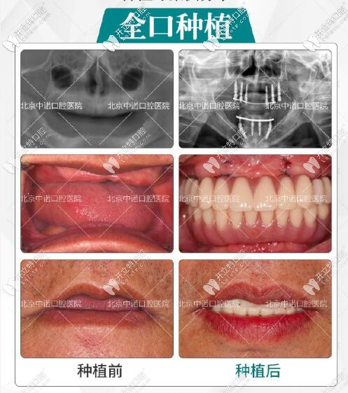 北京中諾口腔全口種植牙真人案例